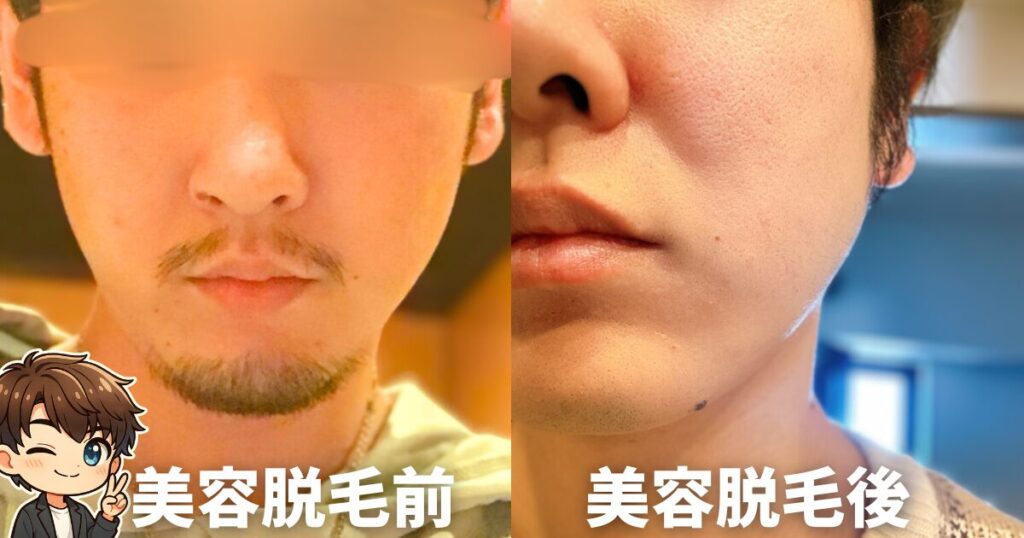 48回脱毛前と48回脱毛後の実際の比較写真