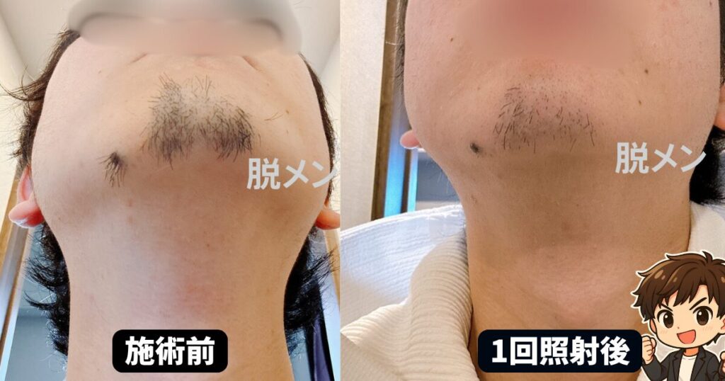 ゴリラクリニック ヤグレーザー1回目の経過写真①