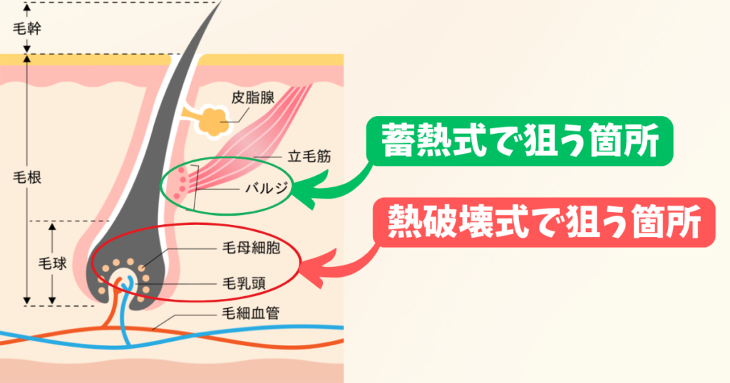 熱破壊式脱毛と蓄熱式脱毛の違い