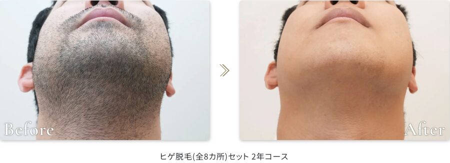 レイロールの症例写真